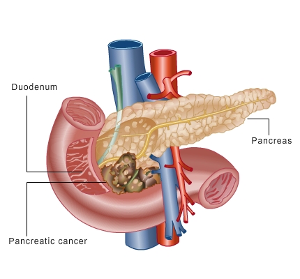 Know about Pancreas Cancer