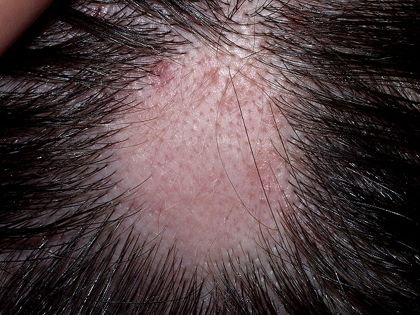 Alopecia, Alopecia Areata, Hair Fall